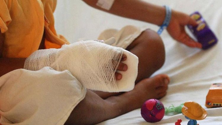 Un menor de 13 años de edad resultó con amputación de una de las falanges distales en la mano derecha y quemaduras de segunda mano.