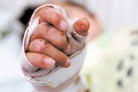 En lo corrido de diciembre van 45 personas quemadas con pólvora