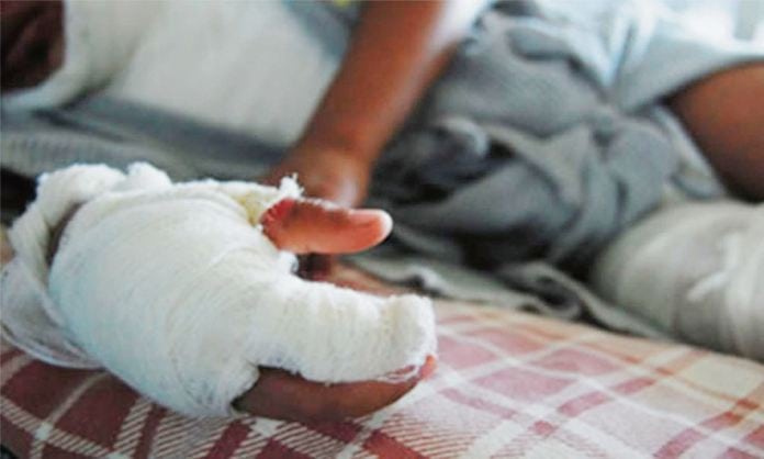 Sube cifra de quemados con pólvora en el Huila